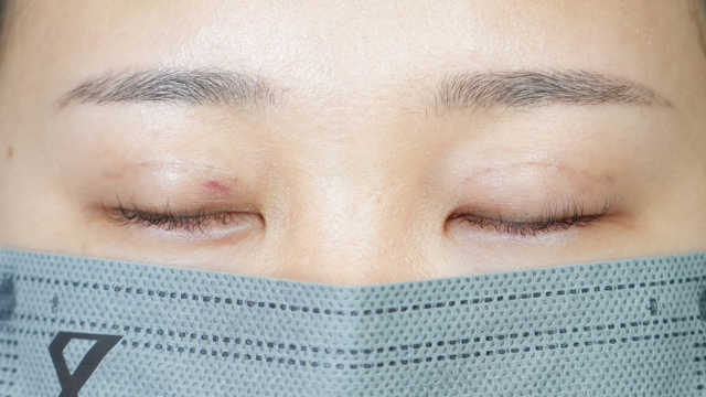 手術前の状態 その1