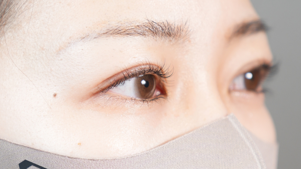 手術前の状態 その1