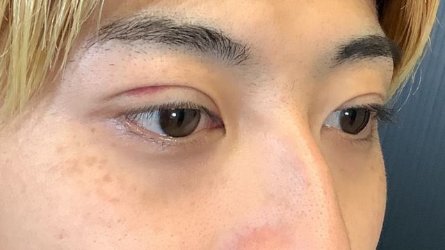 手术前的状态 其一