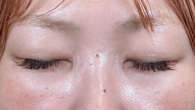 手术前的状态 其一