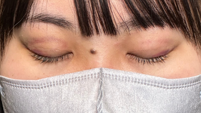 手术前的状态 其一