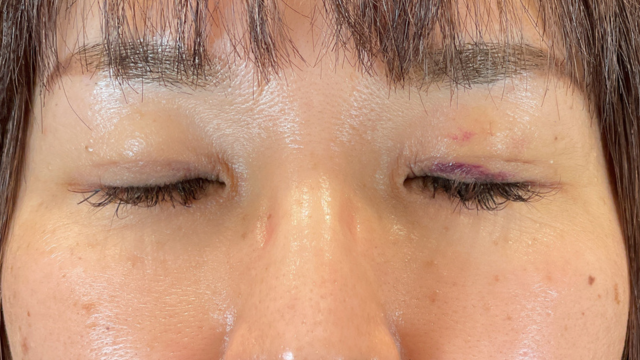 手术前的状态 其一