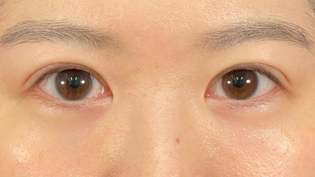 手術前の状態 その1