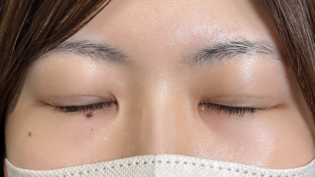 手术前的状态 其一