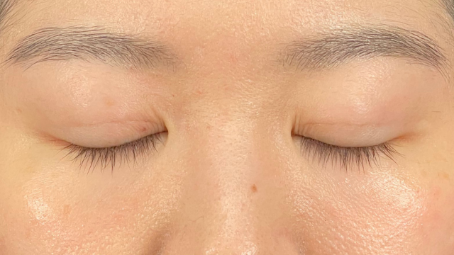 手術前の状態 その1