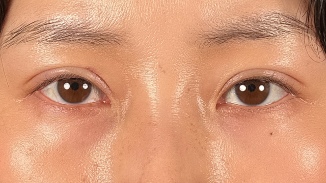 手术前的状态 其一