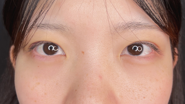 手术前的状态 其一