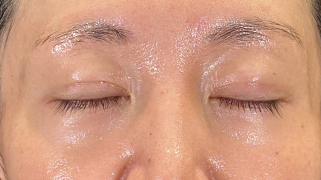 手術前の状態 その1