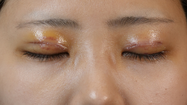 手術前の状態 その1