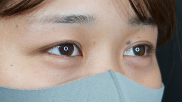 手術前の状態 その1