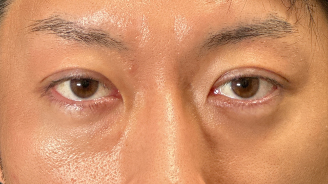 手术前的状态 其一