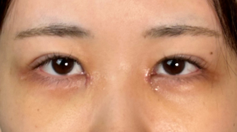 手術前の状態 その1