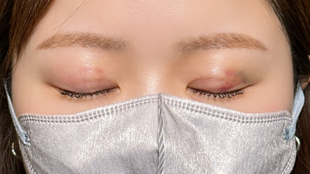 手术前的状态 其一