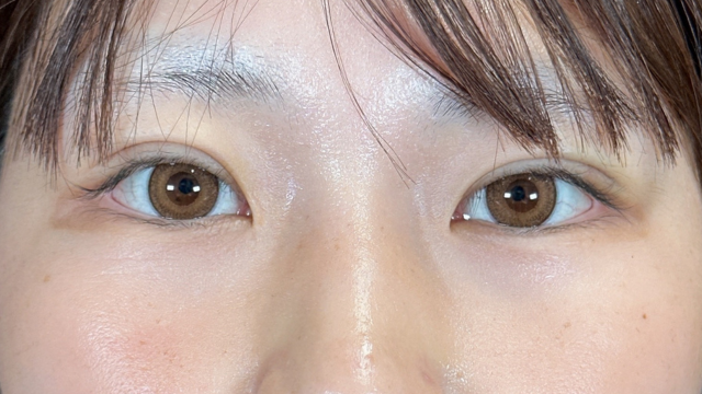 手術前の状態 その1