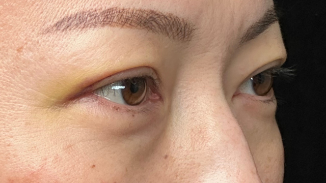 手术前的状态 其一