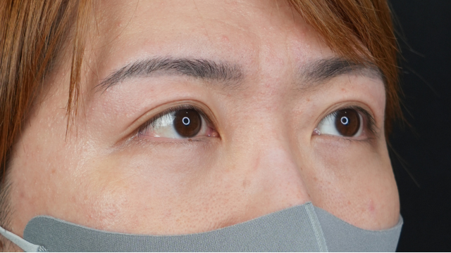 手术前的状态 其一