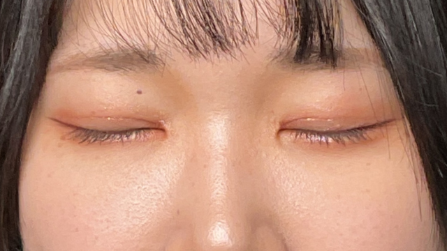 Postoperative Condition Part 1