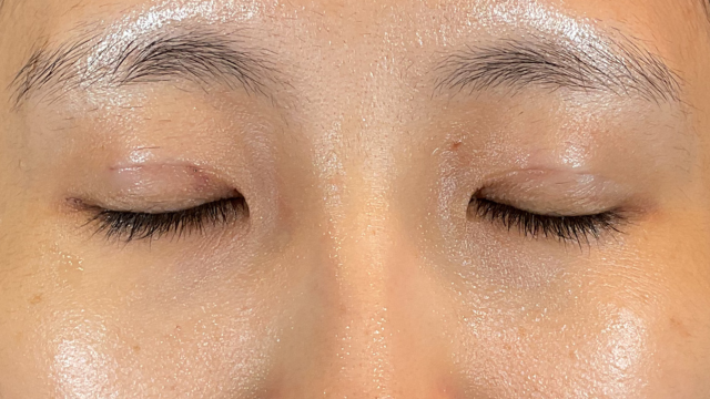 手術前の状態 その1