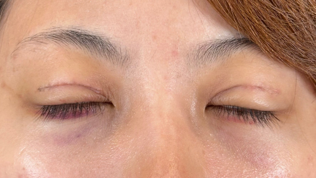 手術前の状態 その1