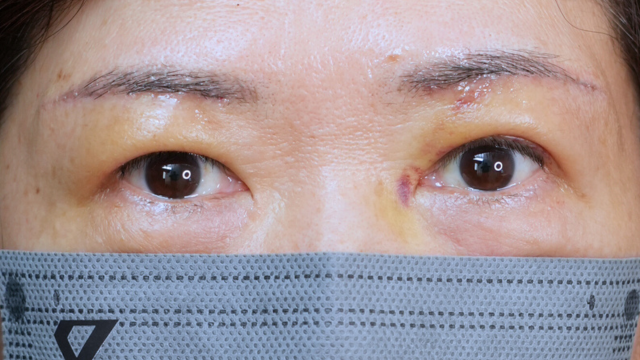 Postoperative Condition Part 1