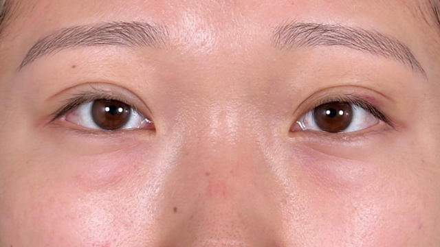 手術前の状態 その1