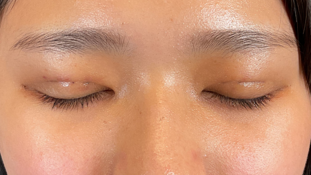 手術前の状態 その1