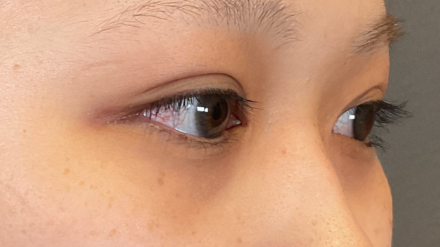 手术前的状态 其一