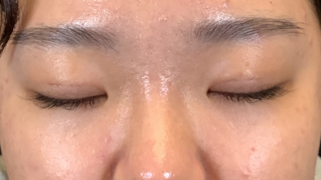 手術前の状態 その1