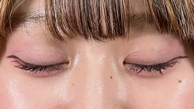 手術前の状態 その1