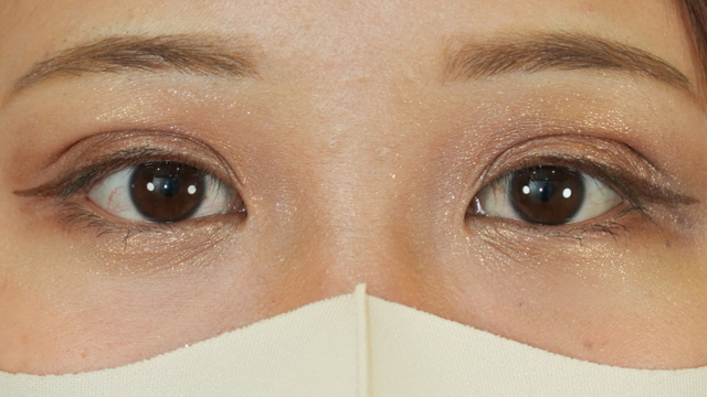 手術前の状態 その1