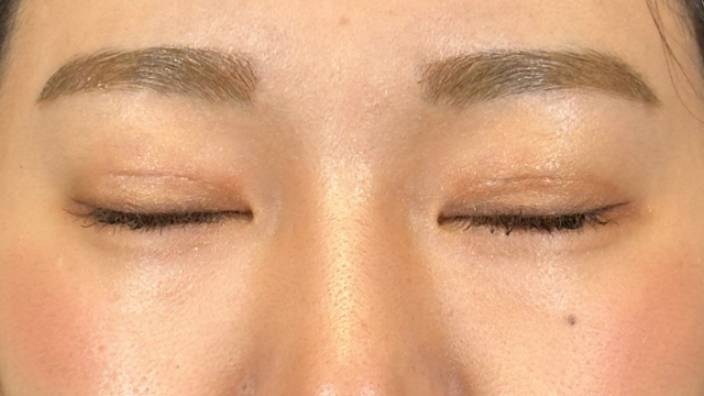 手術前の状態 その1