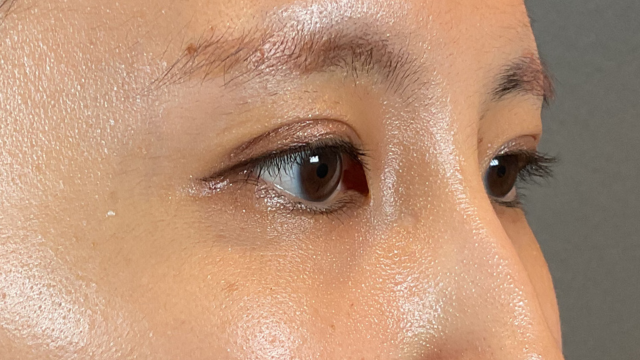 手術前の状態 その1