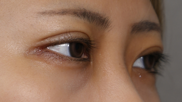 手術前の状態 その1