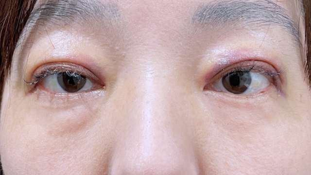 手術前の状態 その1