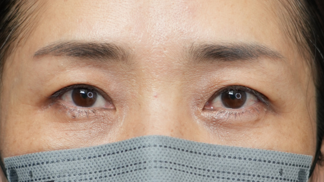 手術前の状態 その1