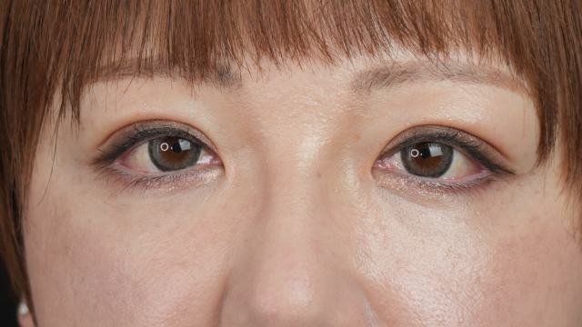 手术前的状态 其一