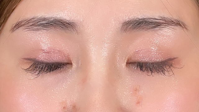 手術前の状態 その1