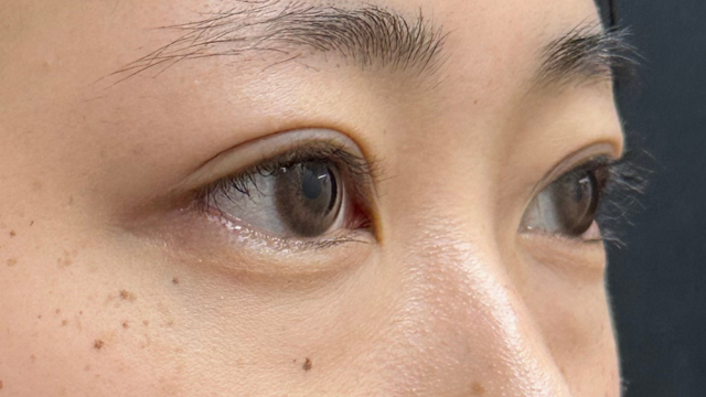 手术前的状态 其一