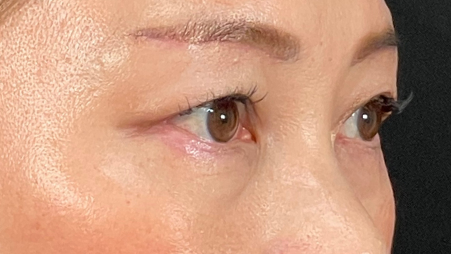 Postoperative Condition Part 1