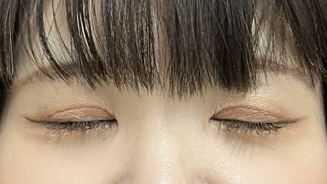 手術前の状態 その1