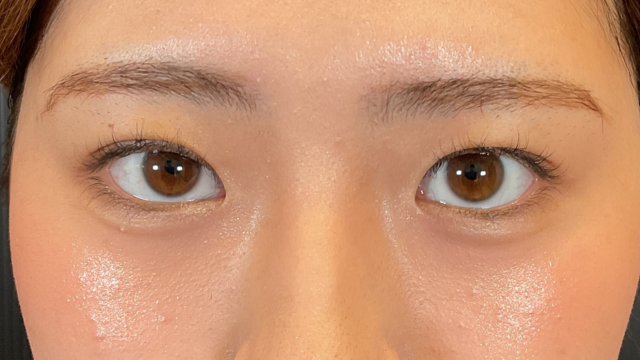 手術前の状態 その1