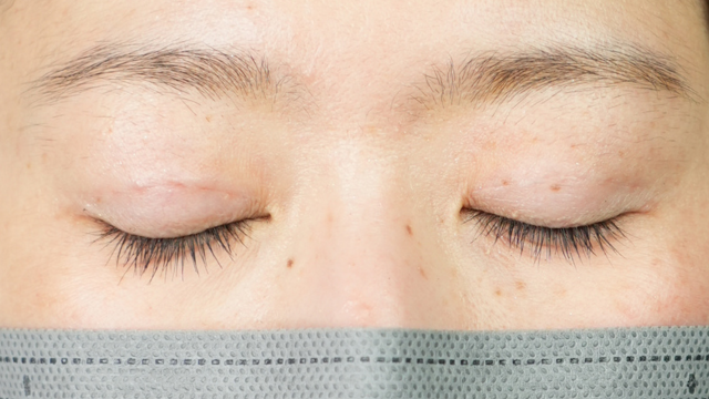 手术前的状态 其一