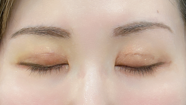 Postoperative Condition Part 1