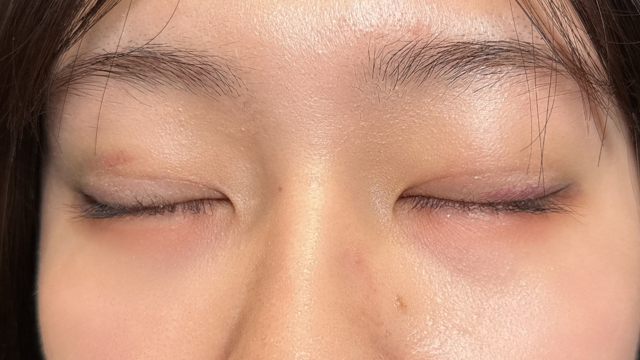 手术前的状态 其一