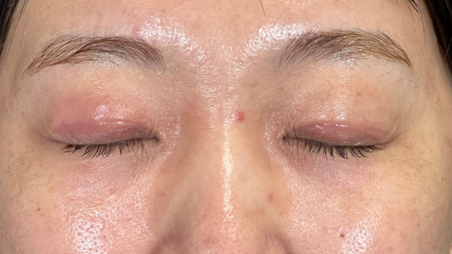 手術前の状態 その1