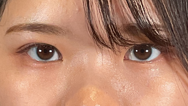 手術前の状態 その1