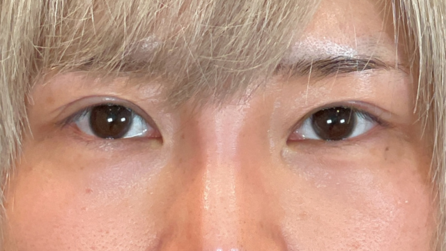 手術前の状態 その1