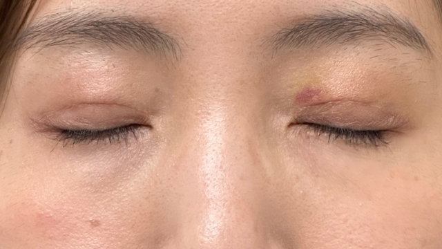 Postoperative Condition Part 1