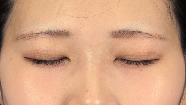 手術前の状態 その1