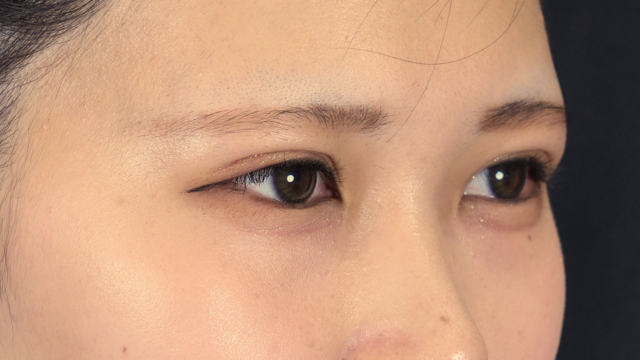 手術前の状態 その1